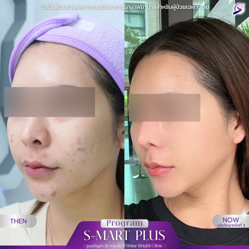 โปรแกรมฉีด Filler ใต้ตา​