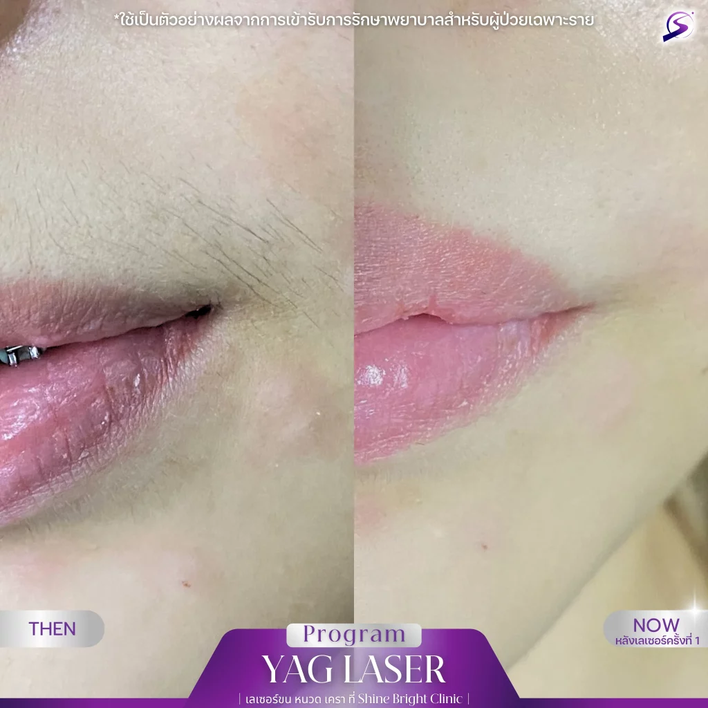 โปรแกรมทรีทเม้นท์ Plasmalis ที่หลัง